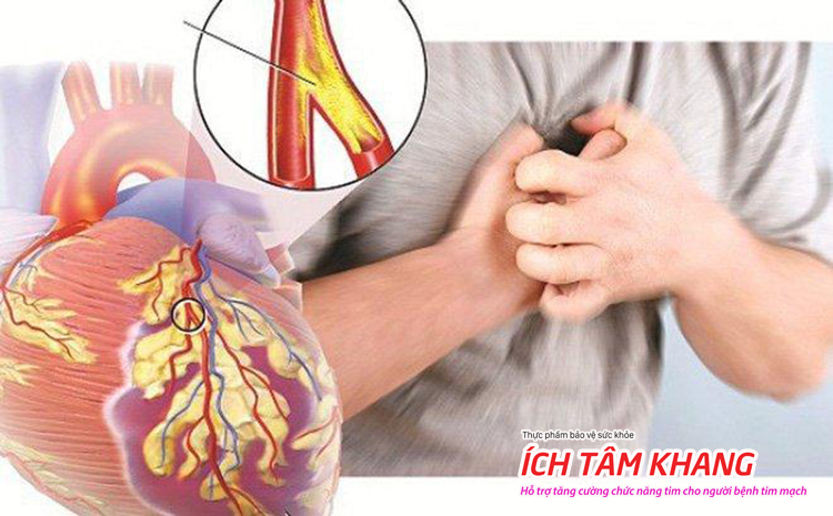 Nhồi máu cơ tim là biến chứng nguy hiểm nhất của xơ vữa động mạch vành.