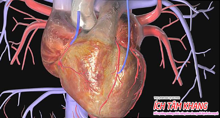 Các vấn đề xảy ra trên mạch vành là nguyên nhân phổ biến nhất của suy tim