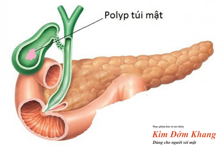 Hình ảnh polyp túi mật