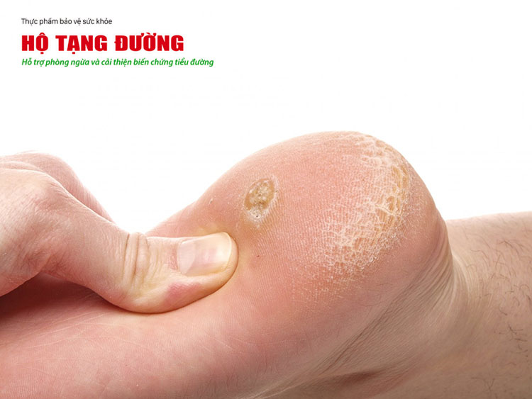 Hình ảnh vết chai chân ở bàn chân người tiểu đường.