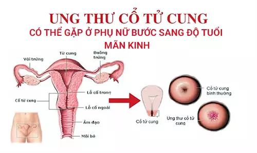 Ung-thu-co-tu-cung-la-mot-can-benh-thuong-gap-o-phu-nu-buoc-sang-do-tuoi-man-kinh