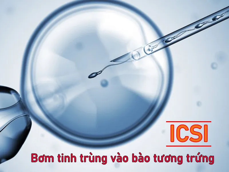 Hỗ trợ sinh sản ICSI: Các bước tiến hành, chi phí thực hiện