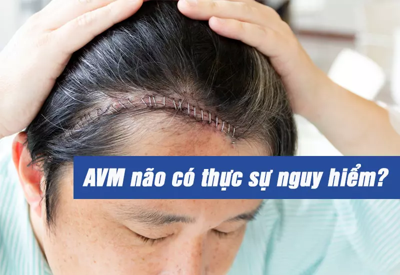 AVM não là bệnh gì? Triệu chứng, nguyên nhân và điều trị