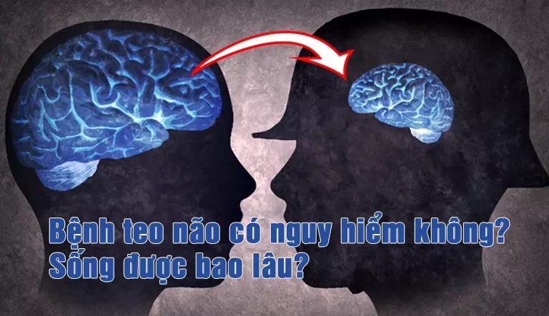 Teo não là gì? Nguyên nhân, triệu chứng và cách phòng ngừa