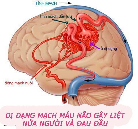 Dị dạng mạch máu não gây liệt nửa người và đau đầu
