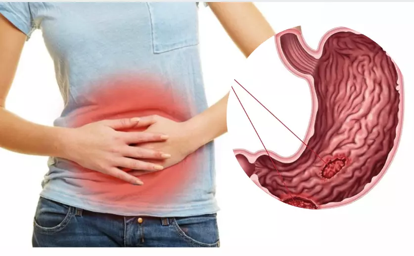 Vạch mặt 10 nguyên nhân gây đau dạ dày: Biết để điều trị 