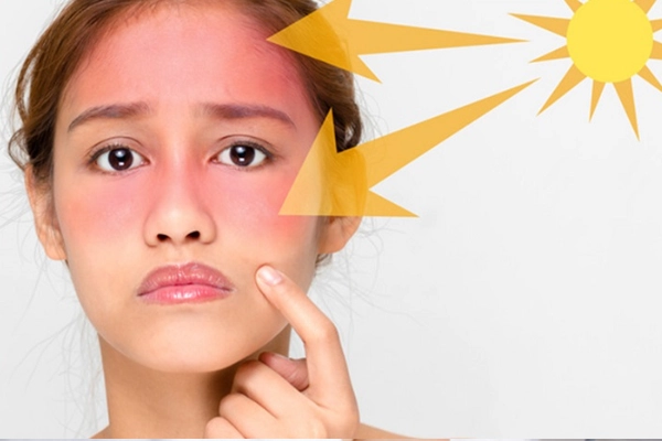 Ánh nắng và tia UV là nguyên nhân phổ biến gây sạm nám da