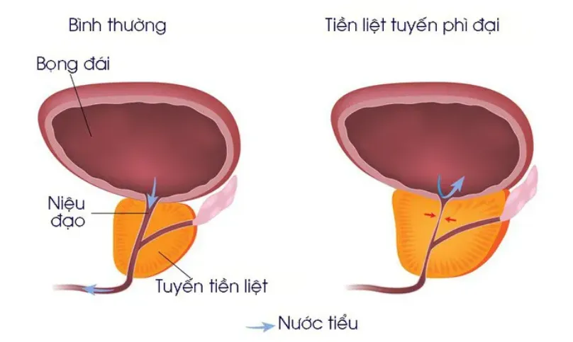 U xơ tiền liệt tuyến là gì? Cách khắc phục triệu chứng bệnh