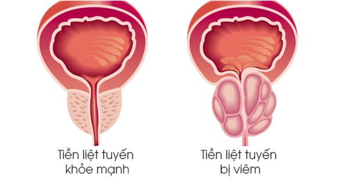 Viêm tiền liệt tuyến là bệnh gì?