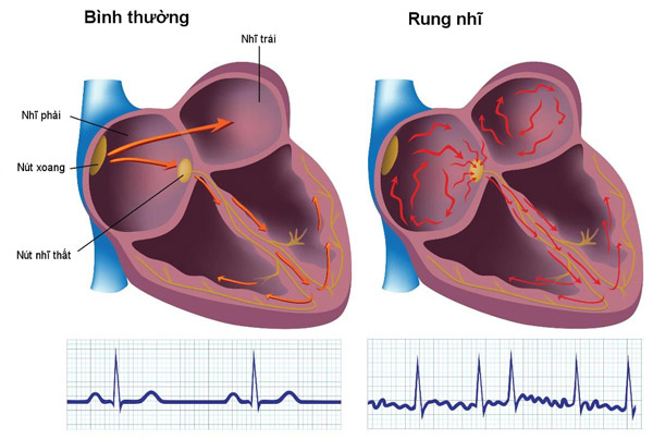 Khi người bệnh hở van tim nặng có thể dẫn đến rung nhĩ thất 