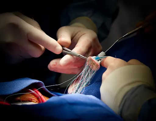 Sửa chữa van tim sẽ được ưu tiên tiến hành, khi không thể sửa thì việc thay thế van nhân tạo là cần thiết