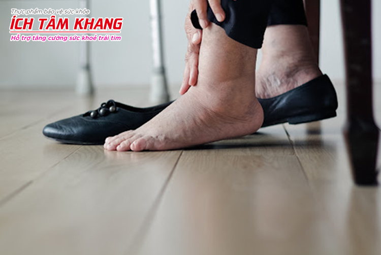 Phù chân là dấu hiệu phổ biến cảnh báo suy tim giai đoạn nặng