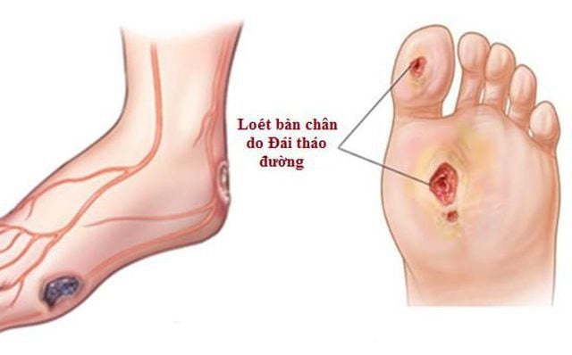 Cần chăm sóc cẩn thận vết loét ở bàn chân do tiểu đường