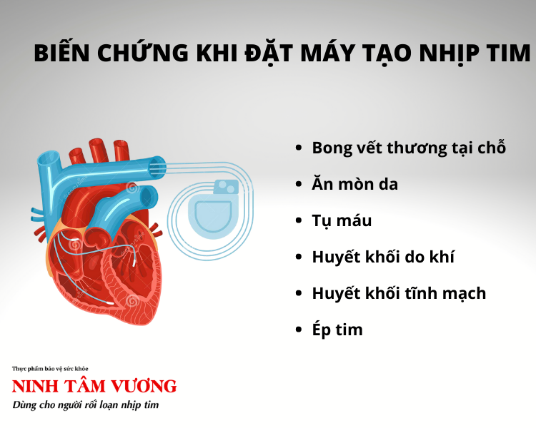 Biến chứng khi sử dụng máy tạo nhịp tim