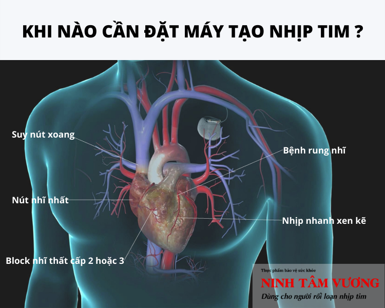 Mắc các bệnh gì cần lắp máy tạo nhịp tim?