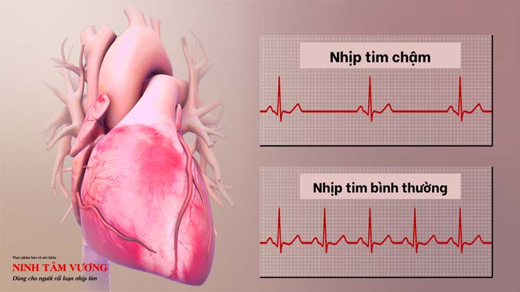 Nhịp tim chậm có thể là bình thường hoặc bệnh lý rối loạn nhịp tim