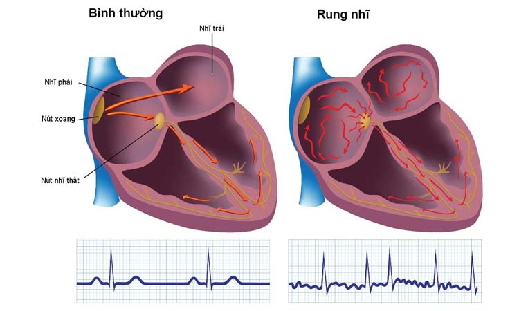 Bệnh rung nhĩ thường gặp ở rối loạn nhịp tim