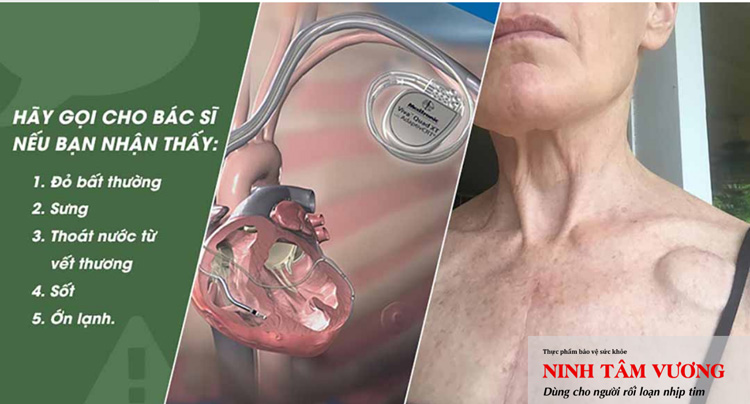 Bệnh nhân sau khi cấy ghép máy khử rung tim có thể gặp một số vấn đề tại vị trí phẫu thuật