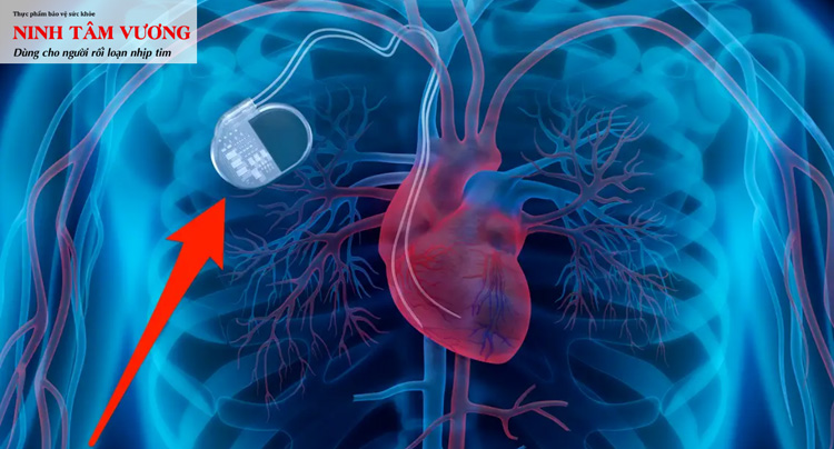 điều trị hội chứng bệnh nút xoang bằng cách cấy máy tạo nhịp tim