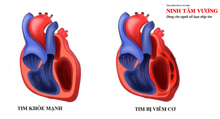 Cơ tim bị viêm ảnh hưởng nhiều đến quá trình dẫn truyền xung động, gây block tim