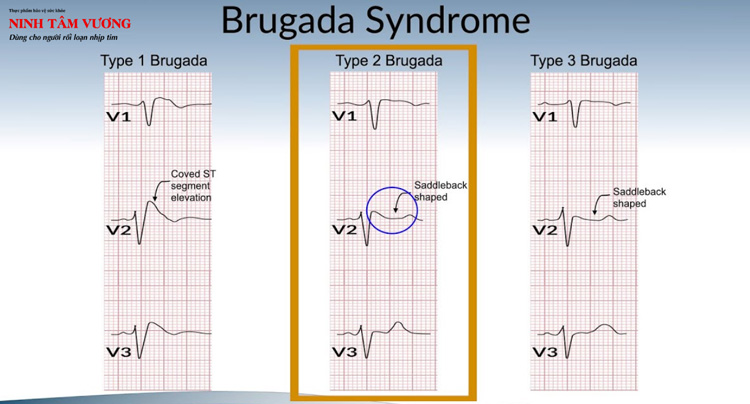 Điện tâm đồ 3 dạng của hội chứng Brugada
