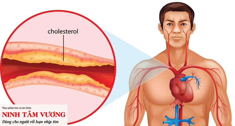 Hàm lượng Cholesterol cao là một trong những yếu tố nguy cơ bệnh block nhĩ thất