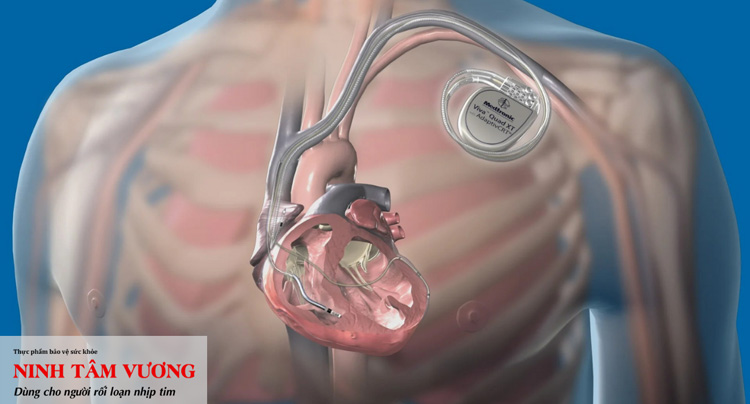 Máy khử rung tim ICD có thể hạn chế nguy cơ tử vong ở bệnh nhân mắc hội chứng Brugada