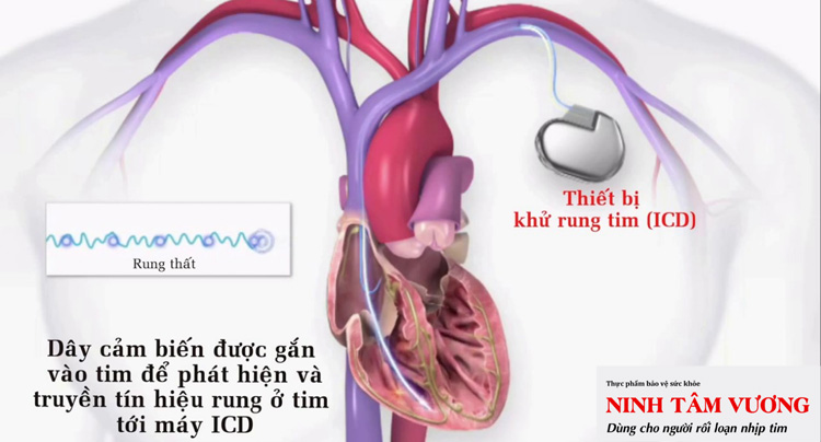 Máy khử rung tim (ICD) - giải pháp kéo dài sự sống cho bệnh nhân suy tim
