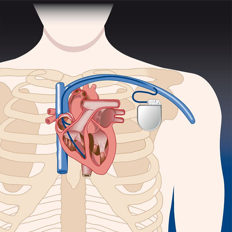 Máy khử rung tim ICD ngăn ngừa rung thất tái phát