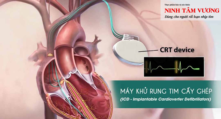 máy khử rung tim là gì