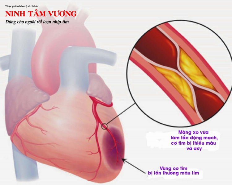 Nhồi máu cơ tim khiến cơ tim bị tổn thương và tăng nguy cơ mắc block nhĩ thất độ 2