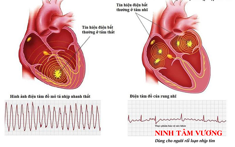 Rung nhĩ và nhịp nhanh thất là các dạng rối loạn nhịp tim phổ biến