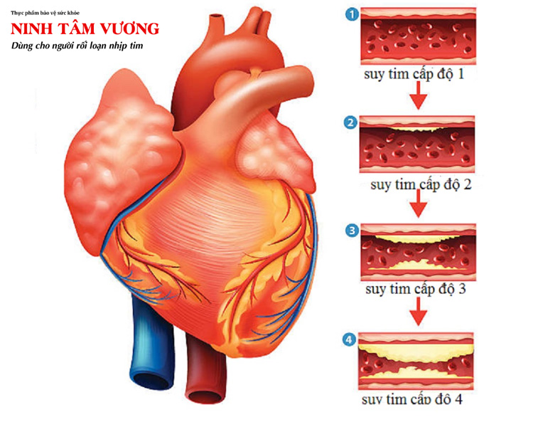 Suy tim là một trong những biến chứng nguy hiểm của block nhĩ thất độ 3