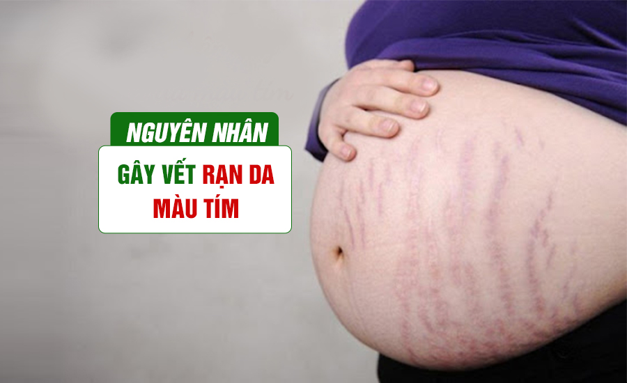 mang-thai-la-nguyen-nhan-gay-vet-ran-da-mau-tim-dien-hinh-nhat