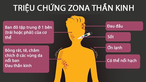 5 thông tin cơ bản bạn cần biết về bệnh zona thần kinh