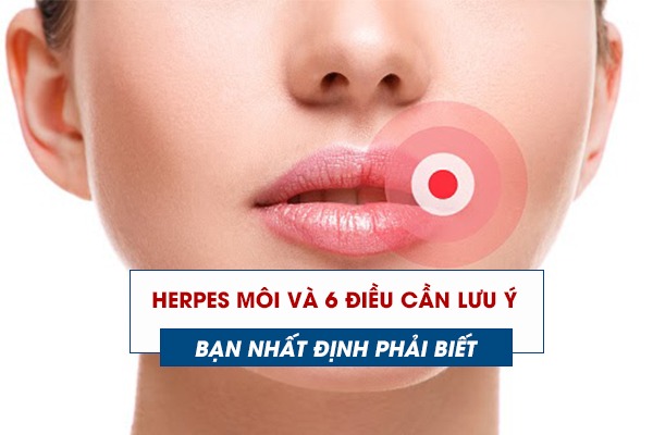 Herpes môi và 6 điều cần lưu ý - Bạn nhất định phải biết
