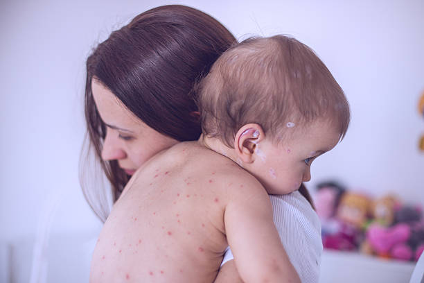 Mẹo đối phó với các bệnh ngoài da do virus ở trẻ bằng nguyên liệu tự nhiên