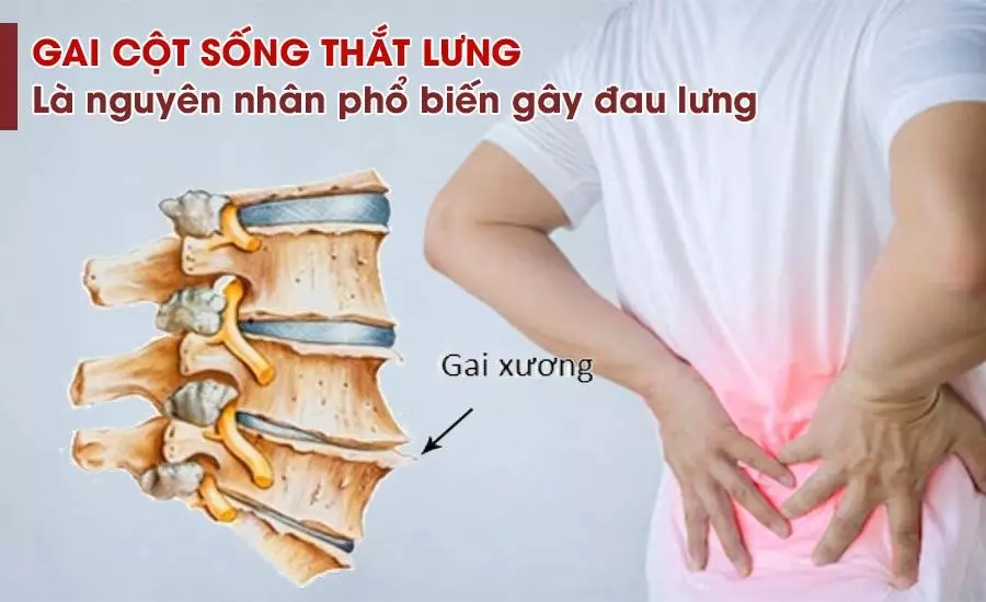 Nguyen-nhan-dau-lung-du-doi-co-the-lien-quan-den-benh-gai-cot-song