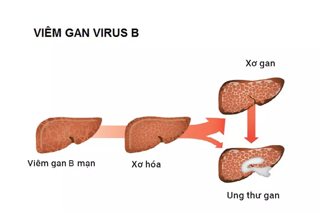 Viêm gan nếu không điều trị có thể dẫn tới xơ gan