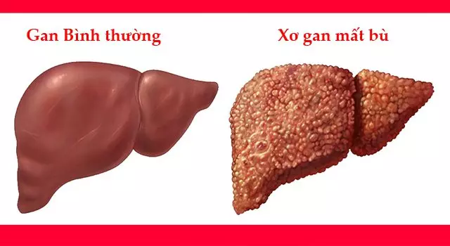 Xơ gan mất bù là giai đoạn mà chức năng của gan bị suy giảm trầm trọng