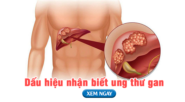 Dấu hiệu ung thư gan - Nhận biết sớm, điều trị kịp thời