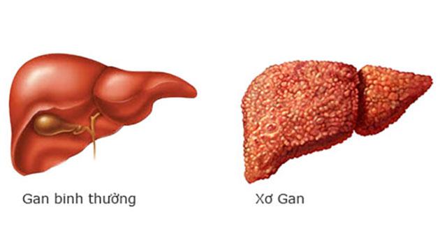 Xơ gan gây rối loạn chức năng chuyển hóa, dự trữ, thải độc