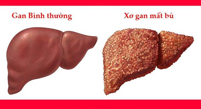  Xơ gan mất bù là giai đoạn cuối của bệnh