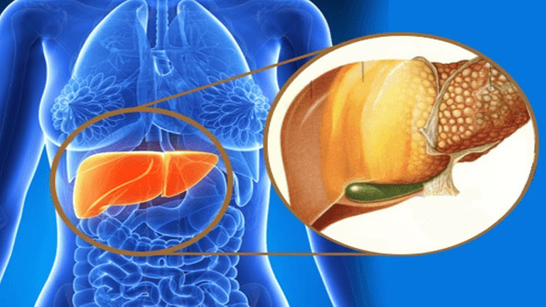 Giải đáp thắc mắc: GAN NHIỄM MỠ ĐỘ 3 CÓ CHỮA KHỎI ĐƯỢC KHÔNG?