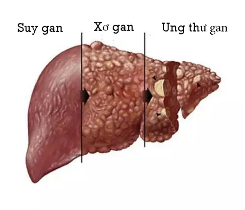 Cac-bien-chung-viem-gan-D-gom-co-suy-gan-xo-gan-ung-thu-gan.webp