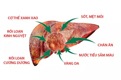 Cac-trieu-chung-suy-te-bao-gan-nhu-sot-chan-an-met-moi-vang-da.webp