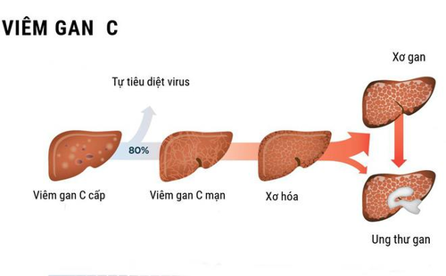 Viem-gan-virus-C-co-the-gay-ung-thu-gan