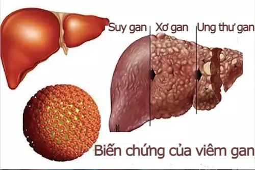 Viem-gan-virus-gay-bien-chung-xo-gan,-suy-gan-ung-thu-gan.webp