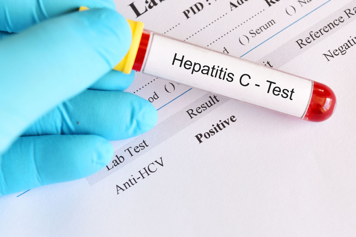 Xet-nghiem-mau-giup-xac-dinh-su-co-mat-cua-virus-HCV