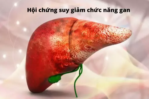 hoi-chung-suy-giam-chuc-nang-gan-thuong-gap.webp